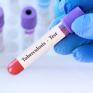 tuberculosis-testing tuberculosis testing el paso